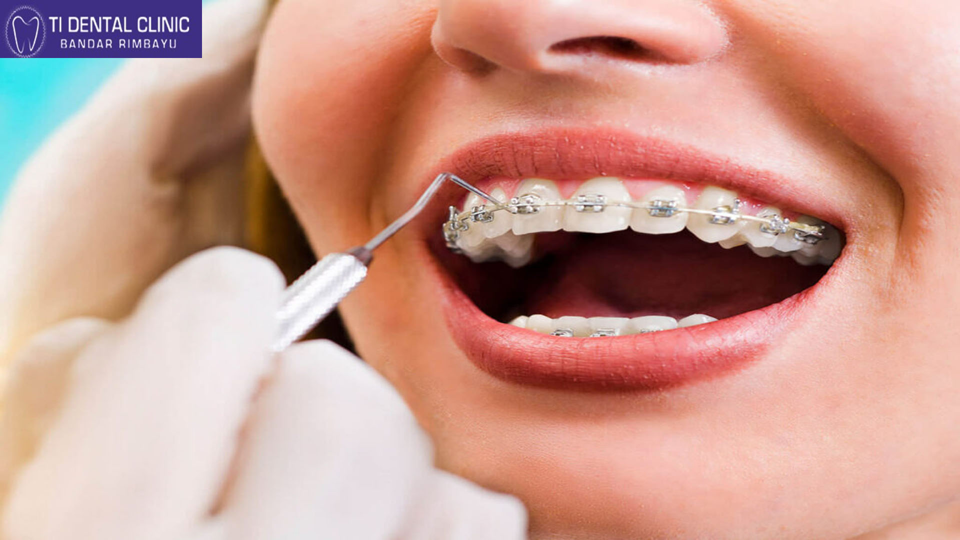 Orthodontic Innovations: Advancements in Braces and Aligners
